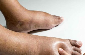 Отечность ног после запоя